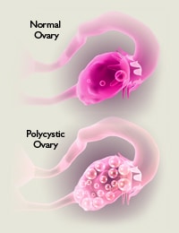 PCOS (Polycystic Ovarian Syndrome)