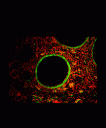 The Low AMH (Anti-Mullerian Hormone) Frenzy