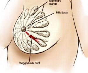 Clearing Blocked Milk Ducts
